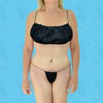 Liposuction Before & After Patient #840