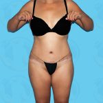 Liposuction Before & After Patient #839