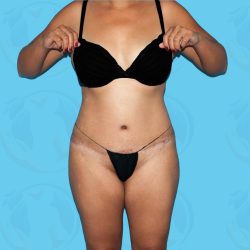 Liposuction Before & After Patient #839