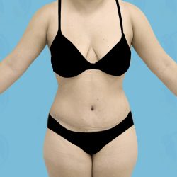 Liposuction Before & After Patient #837