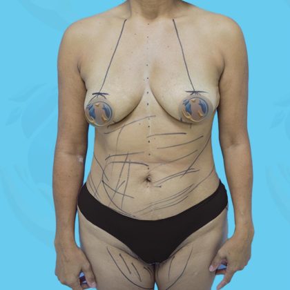 Liposuction Before & After Patient #841