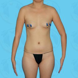 Liposuction Before & After Patient #835