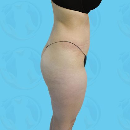 Brazilian Butt Lift Before & After Patient #877