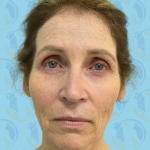 Facelift Before & After Patient #1701