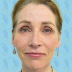 Facelift Before & After Patient #1701