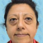 Facelift Before & After Patient #1705