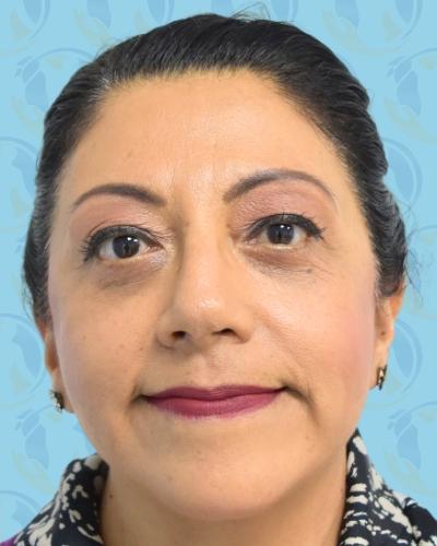 Facelift Before & After Patient #1705
