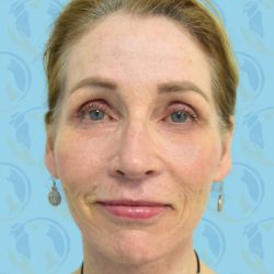 Facelift Before & After Patient #1701