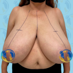 Breast Reduction Before & After Patient #2642