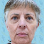 Facelift Before & After Patient #1707