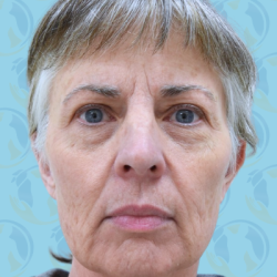 Facelift Before & After Patient #1707