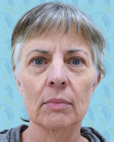 Facelift Before & After Patient #1707