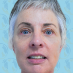 Facelift Before & After Patient #1707