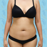 Liposuction Before & After Patient #846