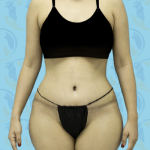 Liposuction Before & After Patient #846