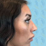Rhinoplasty Before & After Patient #2693