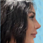 Rhinoplasty Before & After Patient #2693