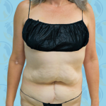 Tummy Tuck Before & After Patient #2709