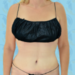 Tummy Tuck Before & After Patient #2709