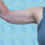Brachioplasty Before & After Patient #2614