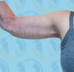 Brachioplasty Before & After Patient #2614