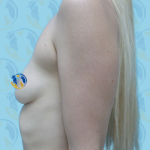 Breast Augmentation Before & After Patient #2630