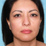 Facelift Before & After Patient #1706
