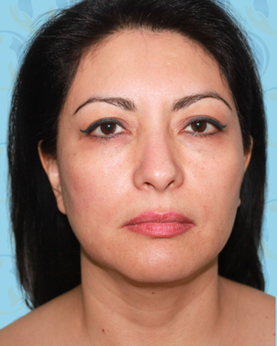 Facelift Before & After Patient #1706