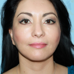 Facelift Before & After Patient #1706
