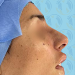 Rhinoplasty Before & After Patient #2692
