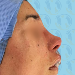 Rhinoplasty Before & After Patient #2692