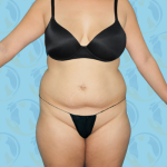 Tummy Tuck Before & After Patient #2710