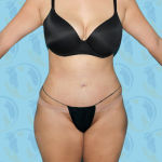 Tummy Tuck Before & After Patient #2710