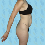 Tummy Tuck Before & After Patient #870