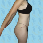 Tummy Tuck Before & After Patient #870
