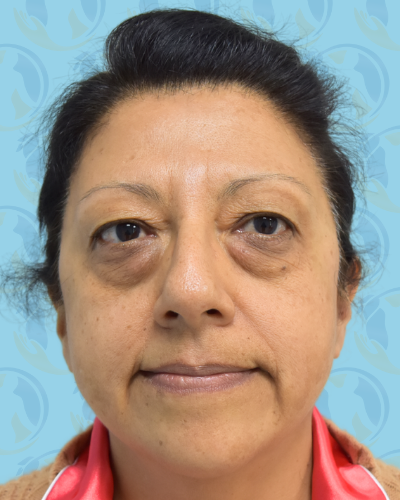 Facelift Before & After Patient #1705