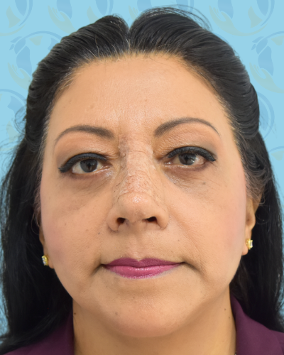 Facelift Before & After Patient #1705