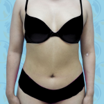 Liposuction Before & After Patient #2666