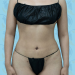Liposuction Before & After Patient #2666