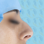 Rhinoplasty Before & After Patient #2691