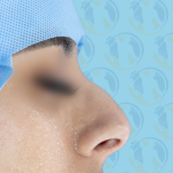 Rhinoplasty Before & After Patient #2691