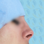 Rhinoplasty Before & After Patient #2691