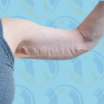 Brachioplasty Before & After Patient #2614