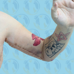Brachioplasty Before & After Patient #2615