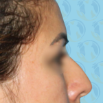 Rhinoplasty Before & After Patient #1441