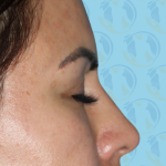 Rhinoplasty Before & After Patient #1441