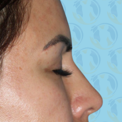 Rhinoplasty Before & After Patient #1441