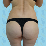 Liposuction Before & After Patient #2670