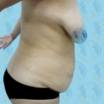 Mommy Makeover Before & After Patient #2677