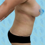 Mommy Makeover Before & After Patient #2677